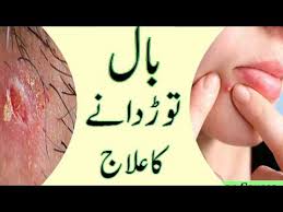 Boils are large and hard pimples that are filled with pus in the center. Bal Tor Dana Ka Ilaj In Urdu How To Get Rid Of A Boil Fast Face