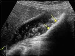 Layer Of Small Stones And Numerous Floating Crystals Longitudinal Cholesterol Bile Duct Sonography