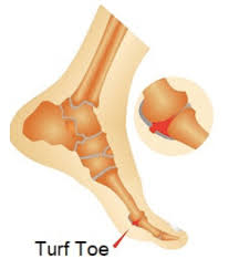 The power to move the mtp joint is provided by both intrinsic ( flexor. Turf Toe Injuries Mtp Sprain Insync Physiotherapy