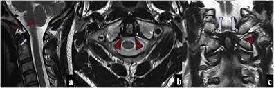 Red = anterior body line brown = posterior body line (george's line) green= spinolaminar (junction) line blue = posterior spinous line. Imaging Of Cranio Cervical Junction Traumas European Journal Of Radiology