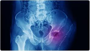 Image result for Osteosarcoma