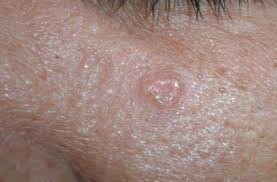 Image result for Sebaceous Hyperplasia