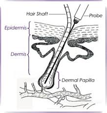 Excess facial and body hair can be a as we said, there are three modalities of electrolysis that are galvanic (chemical process). Electrolysis Hair Removal Permanent Facial Hair Removal For Women
