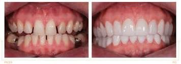 Metamorfozy uśmiechu - kompleksowe leczenie zębów 2021 ...
