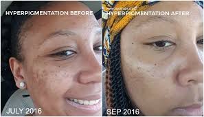 A study found that when applied to natural ingredients usually do not have major side effects unless you are allergic to them or have the treatment you undergo depends on the cause of your hyperpigmentation. Hyperpigmentation And All Natural Skin Care Regimen Update Hyperpigmentation Natural Skin Care Regimen Hyperpigmentation Treatment