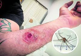 Image result for Tarantula Bite