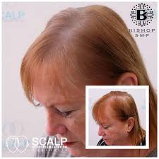 Information and advice on hair loss, the treatments that work, and the ones that don't. Scalp Micropigmentation Or Hair Tattooing For Women Smp Australia