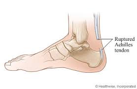 Traditionally, crutches were used to keep weight off the leg during the first few weeks of treatment. Achilles Tendon Repair What To Expect At Home