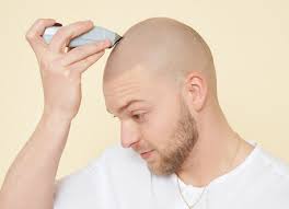 Before pic · step 2: Does Scalp Micropigmentation Look Real Scalp Micro Usa