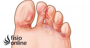 El signo más común para saber si titnes hongos en las uñas es que tu uña crezca más gruesa que de costumbre, pero también que la veas descolorida, o muy blanca, negruzca, verdosa o amarillenta. Ampollas En Los Pies Prevencion Y Tratamiento Fisioonline