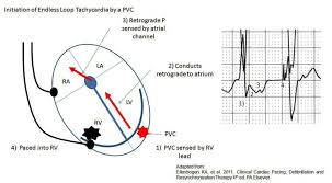 Some types of pacemakers generate impulses on demand. Pacemaker Basics Rebel Em Emergency Medicine Blog