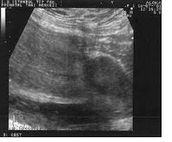 Diagnostic Ultrasonography In Gynecology | Glowm