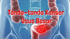Blog Wahm Ibu Berbisnes Dari Rumah Tanda Tanda Kanser Usus Besar Atau Kanser Kolorektal