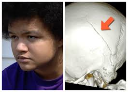 Rockford Student Suffers Brain Damage after being Body Slammed by a Cop