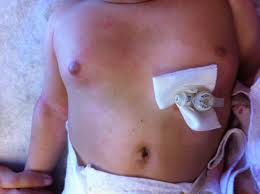 A Breast Mass In A 5 Month Old Girl Consultant360