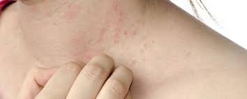 People taking hiv medicines need to know about this condition. Skin Rashes Healthengine Blog