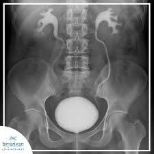 Image result for Voiding Cystourethrogram