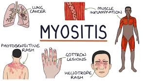 Image result for Dermatomyositis