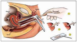 Bagi anda yang ingin melakukan tes ini, biaya yang harus dikeluarkan mulai dari rp150.000. Apa Itu Pap Smear Rskb Banjarmasin Siaga