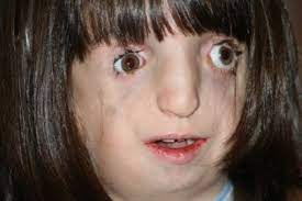 Sindrome De Treacher Collins O Que E Causas Sintomas E Tratamento Tua Saude