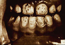 Children should be given instructions about how to properly brush and rinse. Dental Fluorosis Wikipedia