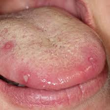 Image result for mouth ulcer on tongue)