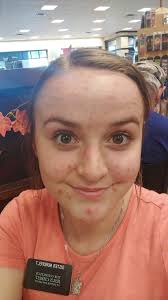 What to do about acne around the mouth and