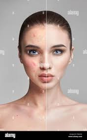 Image result for acne face