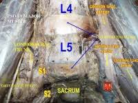 Degenerative Disc Disease Physiopedia