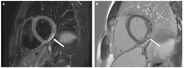 Image result for Cardiac MRI