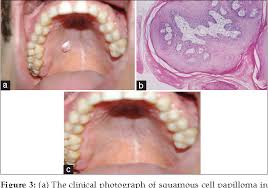 Image result for spinocellular carcinoma of the oral cavity