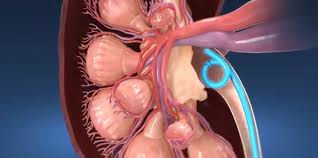 Ureteral Stent My Kidney Stone Boston Scientific