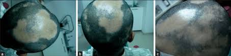 Microneedling bequem und günstig online bestellen. Microneedling For Hair Growth Is It Effective Hairguard
