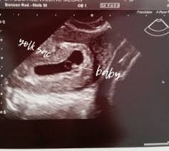 Maybe you would like to learn more about one of these? 8 Week Scan Measuring 6 Weeks November 2017 Babycenter Australia