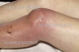 Image result for Septic Joint