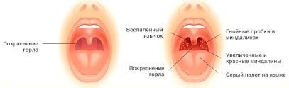 Bol V Gorle Bolno Glotat Simptomy Pochemu Bolit Gorlo Oslozhneniya Lechenie