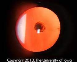 Red Reflex Showing Posterior Polar Cataract Of The Right Eye Cataract Optometry The University Of Iowa