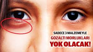 Goz Alti Morluklari Icin Maske Tarifi 3 Malzemeyle Yok Olacak Maskeler Gozler Dogal Cilt Bakimi