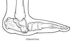 He is best known today for his work on hypnosis and hysteria, in particular his work with his hysteria patient louise augustine gleizes. Charcot Foot Foot Health Facts