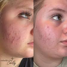 Acne Bootcamp Baby progress update! The first photo was taken in October  when she started the Acne Bootcamp program with me, and she sent me the  second picture today! She and I