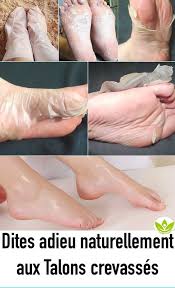 Dites Adieu Naturellement Aux Talons Crevasses Peeling Mask Natural Hair Mask Brown Spots On Face