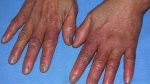 I am not sure what to make of the orange spots however, my apologies. Chilblains On Fingers Toes And Feet Causes Pictures Treatment