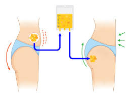 Fajas compression swelling post op care after bbl tummy tuck. Why Is Brazilian Butt Lift Surgery So Popular Ariamedtour