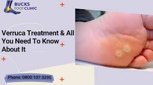 Image result for verruca