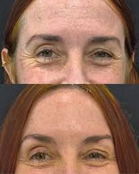 Resultado real do nosso protocolo TricoHealth! Cabelos mais cheios,  saudáveis e com crescimento visível já nas primeiras semanas. Essa  transformação é fruto de um tratamento personalizado que age na causa da  queda