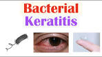 Bacterial Keratitis (Eye Infection From Contact Lenses ...