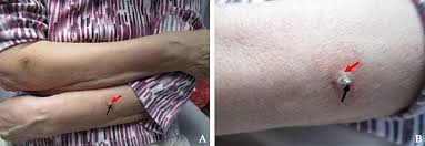 Image result for cornu cutaneum)