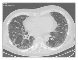 Effective Treatment Of Rheumatoid Arthritis Associated Interstitial Lung Disease By B Cell Targeted Therapy With Rituximab