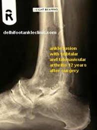 All Joint Replacement Surgeries Particularly Total Ankle Replacement Provide Evidence Based Economical Foot Ankle S Ankle Replacement Joint Replacement Ankle
