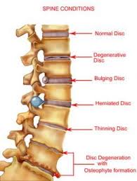 Pin On Recovery How I Survive My Back Injury